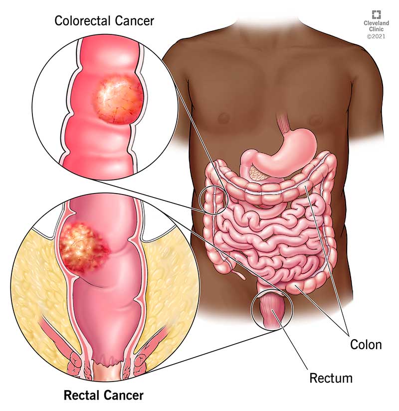 anal cancer symptoms