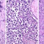 Anaplastic Types, Causes, and Treatments anaplastic