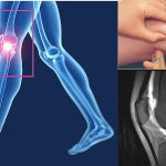Demystifying Arthrograms: What You Need to Know arthrogram