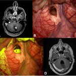 Astrocytoma Symptoms, Diagnosis, and Treatment astrocytoma