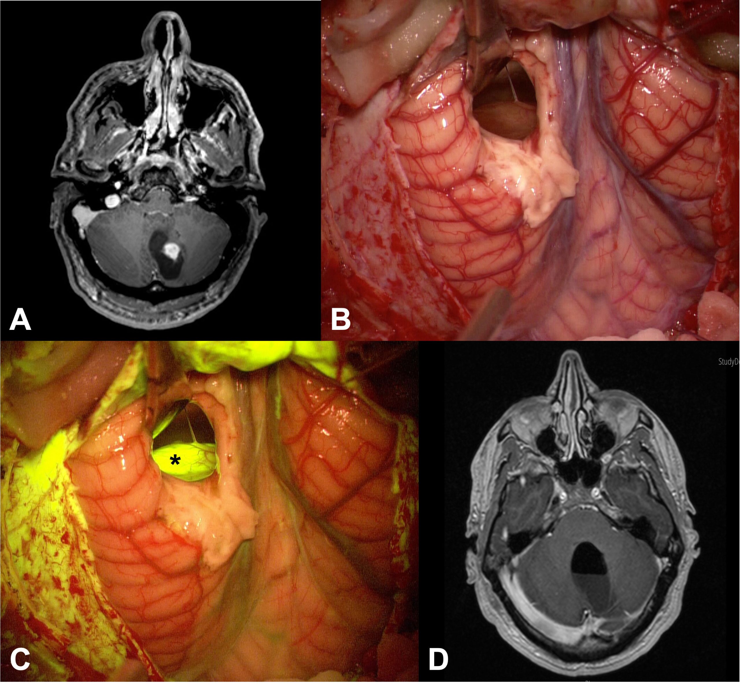 astrocytoma