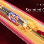Atherectomy: Advanced Artery Clearing for Better Health atherectomy