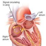 Deciphering Atrial Tachycardia: Causes, Symptoms, and Solutions atrial tachycardia