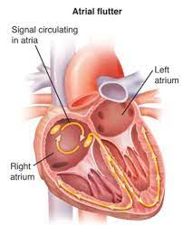 atrial tachycardia