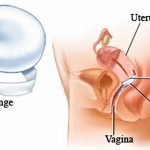 Choosing the Right Birth Control Sponge A Comprehensive Guide birth control sponge