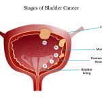 Bladder Cancer Survival Rate What You Need to Know bladder cancer survival rate