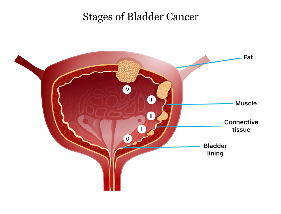 bladder cancer survival rate