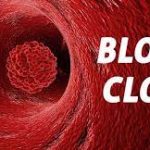 Dealing with a Blood Clot in Finger: Causes, Symptoms, and Solutions blood clot in finger