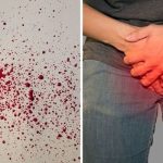 Hematospermia Causes, Symptoms, and Treatment blood in semen