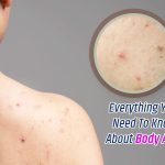 Banish Body Acne: Tips for Clearing Your Skin Confidently body acne