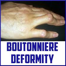 boutonniere deformity