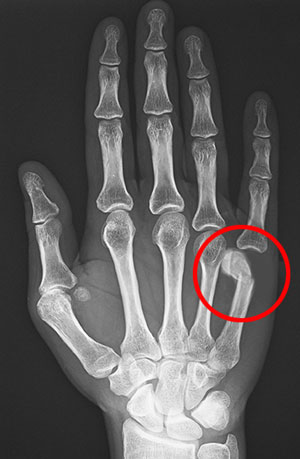 boxer's fracture