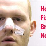 Dealing with a Broken Nose Causes, Symptoms, and Treatment broken