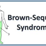 Brown-Séquard Syndrome: Causes, Symptoms, and Treatment Explained brown sequard syndrome