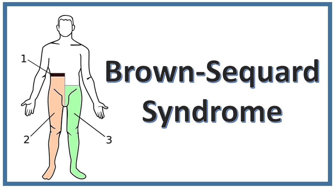 brown sequard syndrome