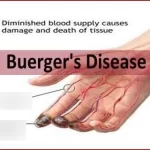 Buerger’s Disease Explained: Symptoms, Causes, and Treatments buerger's disease