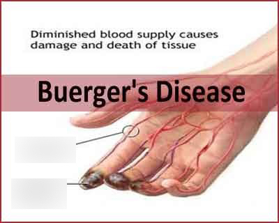 buerger's disease