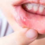 Bump in Mouth: Causes, Symptoms, and Treatment bump in mouth