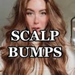Dealing with Bumps on Scalp: Causes, Remedies, and Prevention bumps on scalp