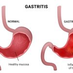The Burning Sensation in Stomach Causes, Remedies, and Prevention burning sensation in stomach