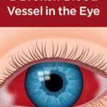 Dealing with a Burst Blood Vessel in Eye: Causes, Symptoms, and Care burst blood vessel in eye