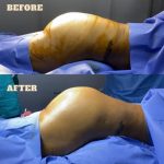 Enhancing Curves The World of Butt Implants Demystified butt implants