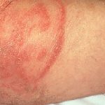 Managing Butt Rash Causes, Symptoms, and Remedies butt rash