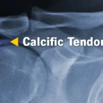Calcific Tendonitis: Causes, Symptoms, and Relief calcific tendonitis
