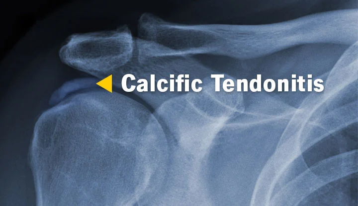 calcific tendonitis