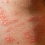 Can You Get Shingles More Than Once can you get shingles more than once