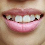 The Remarkable Canine Teeth Their Role in Human Evolution canine teeth human