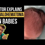 Cephalohematoma Causes, Symptoms, and Treatment cephalohematoma
