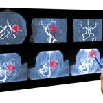The World of Cerebral Angiograms A Closer Look at Brain Health cerebral angiogram