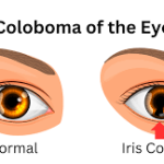 Coloboma: Insights into a Rare Eye Anomaly coloboma