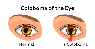 coloboma