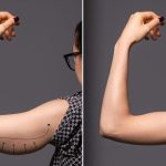 CoolSculpting Arms Before and After coolsculpting arms before and after
