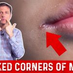 Soothing Solutions for Cracked Lip Corners Causes, Remedies, and Prevention cracked lip corners