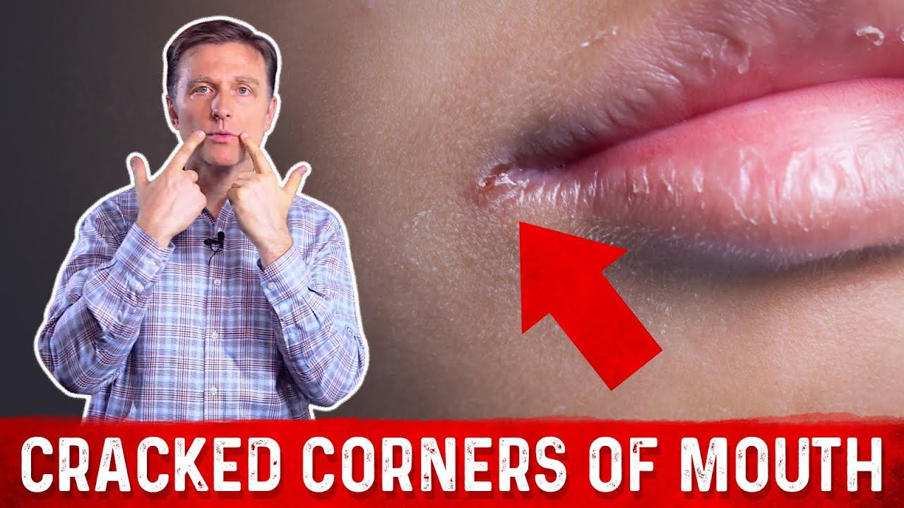 cracked lip corners