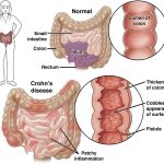 Crohn’s Disease Surgery A Comprehensive Guide to Treatment Options crohn's disease surgery