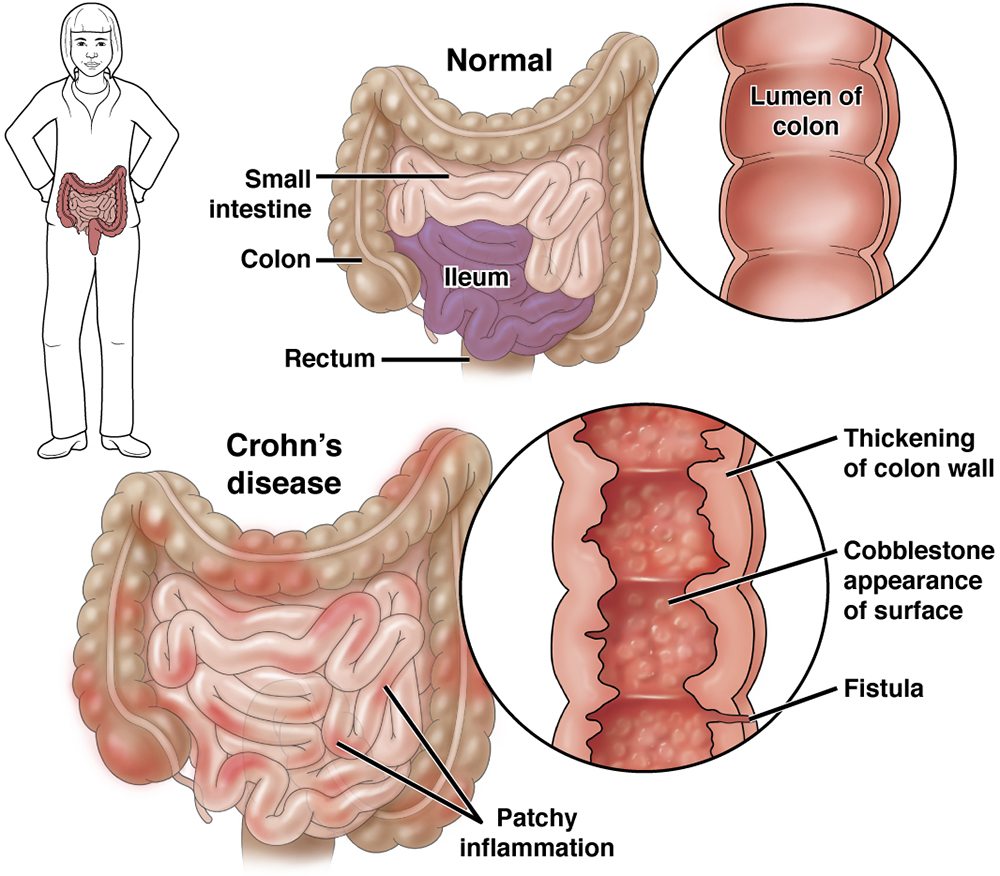 crohn's disease surgery