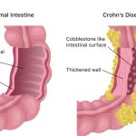 Navigating Crohn’s Disease Surgery Your Options crohn's disease surgery