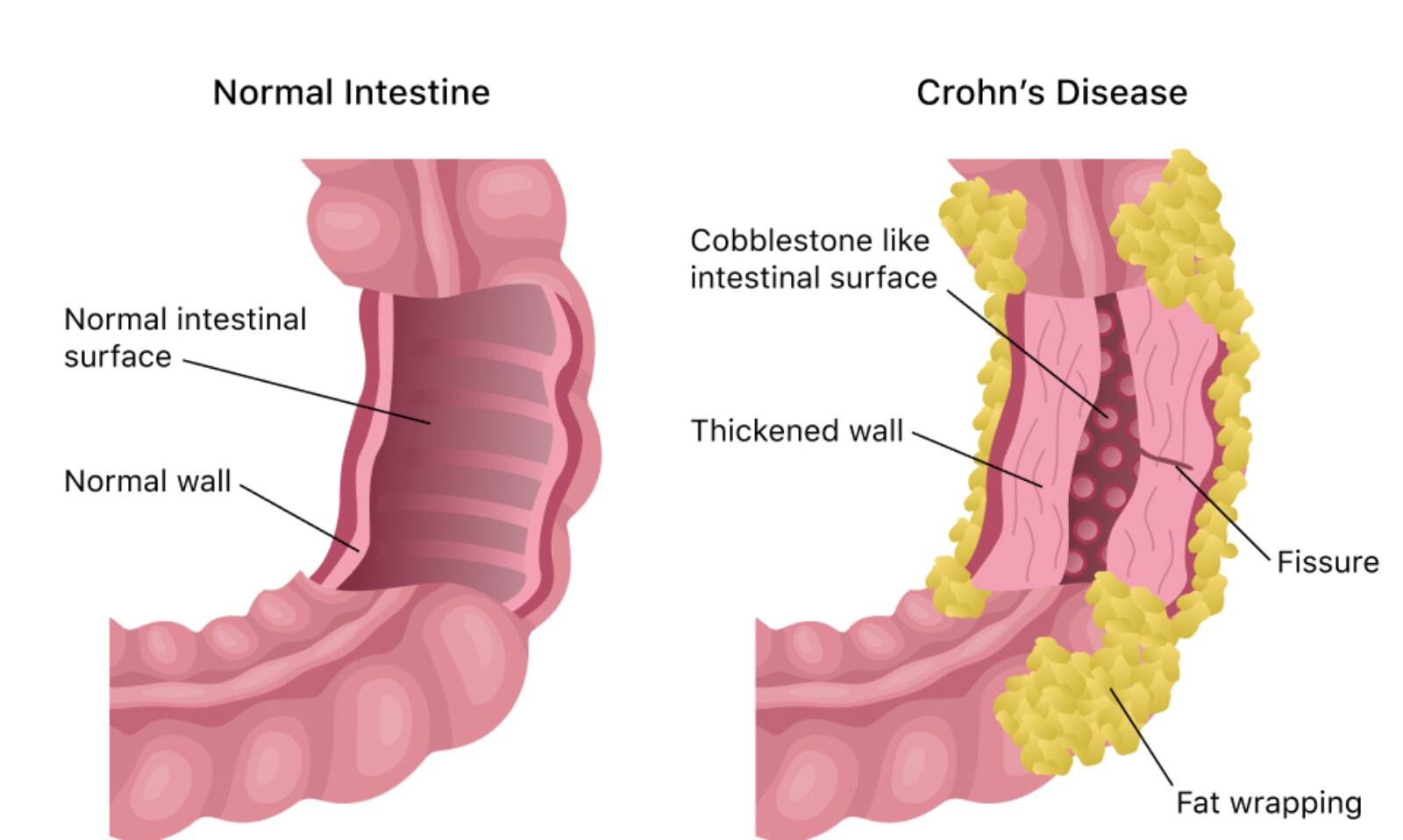 crohn's disease surgery