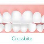 Cross Bite: Causes, Symptoms, and Treatment Options cross bite