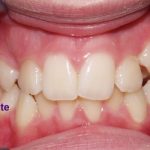 Crossbite Causes, Types, and Treatment crossbite