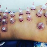 Discover the Benefits of Cupping Therapy Near Me cupping therapy near me