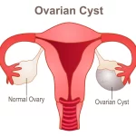 Mastering Cystectomy: Everything You Need to Know cystectomy
