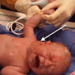 Cystic Hygroma Causes, Symptoms, and Treatment cystic hygroma