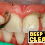 Achieve Sparkling Smiles the Secrets of Deep Cleaning Teeth deep cleaning teeth
