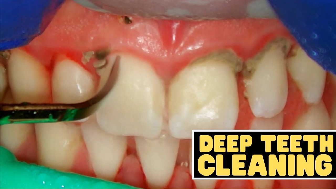 deep cleaning teeth