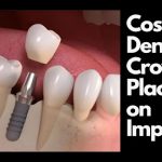 Demystifying Dental Crown Cost: What to Expect dental crown cost